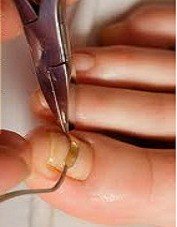 pedicure leczniczy