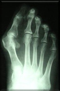 hallux