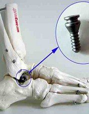 implant podskokowy