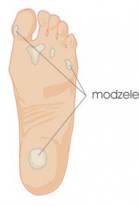 modzele usuwanie