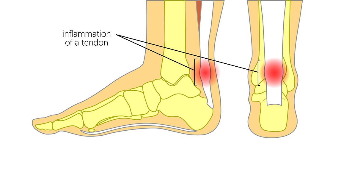 Zapalenie ścięgna Achillesa