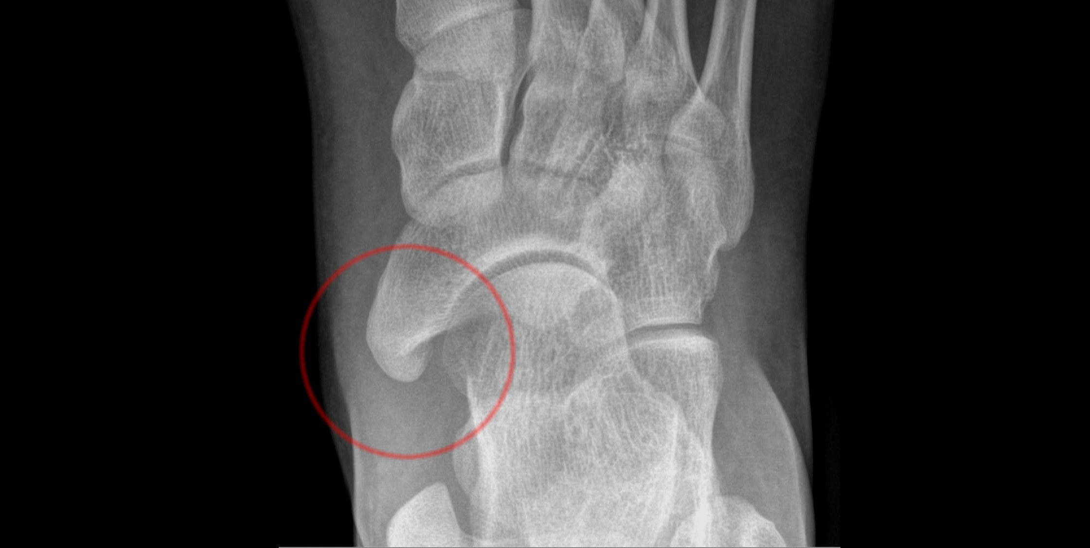 Dodatkowa kość łódkowata