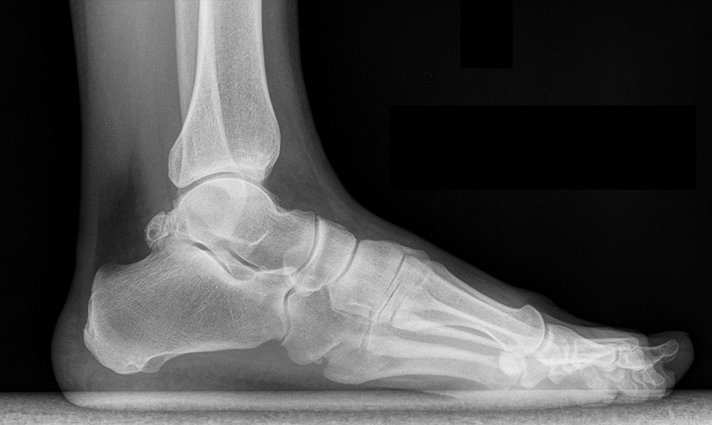 Zespół kości trójkątnej