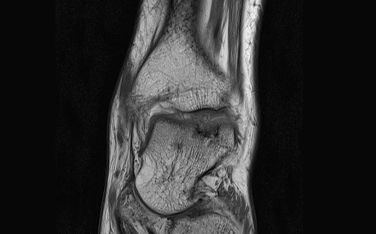 Złamania kostno-chrzęstne