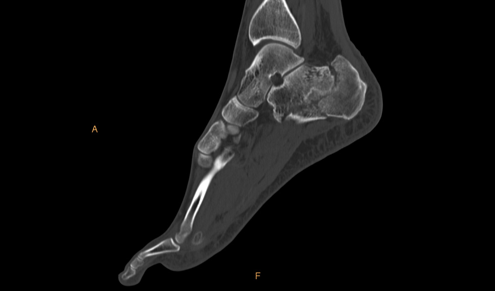 Złamanie kości piętowej