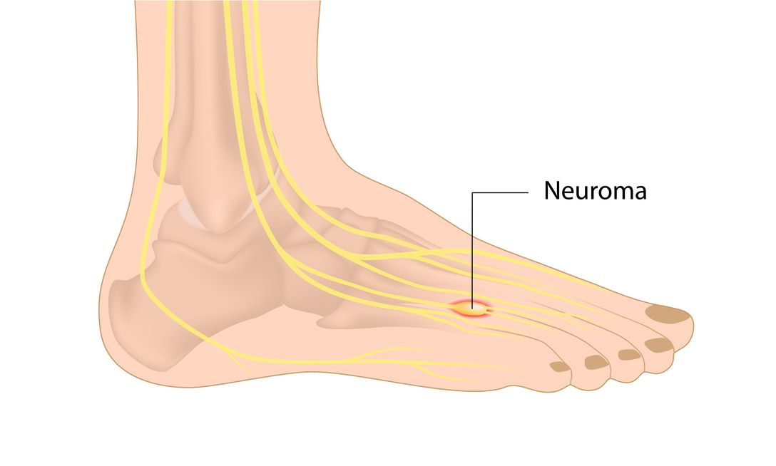 Nerwiak Mortona (neuralgia Mortona)