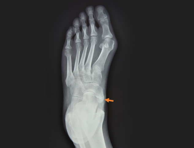 Dodatkowa kość łódkowata