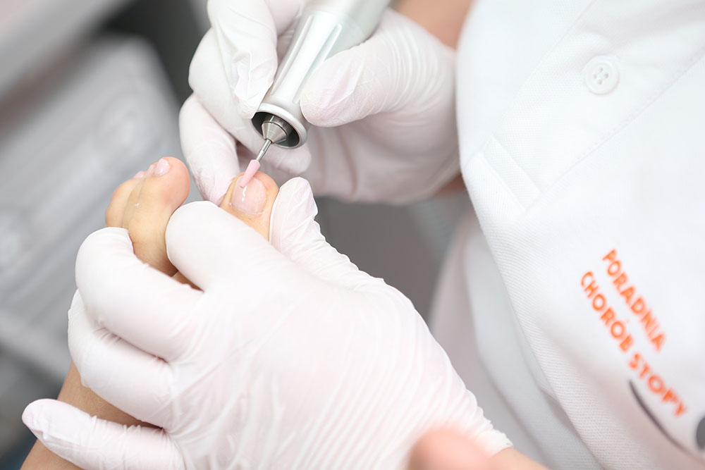 Paznokieć grzybiczy