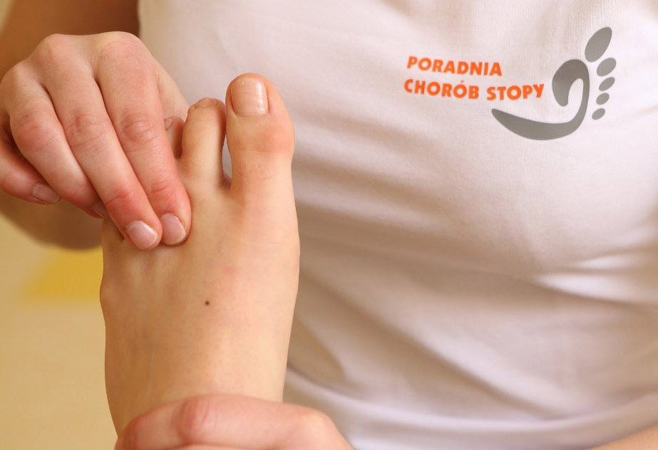 Rehabilitacja po operacji palców młotkowatych