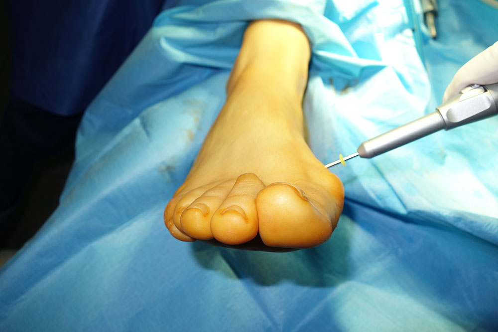 Miniinwazyjne operacje palucha koślawego