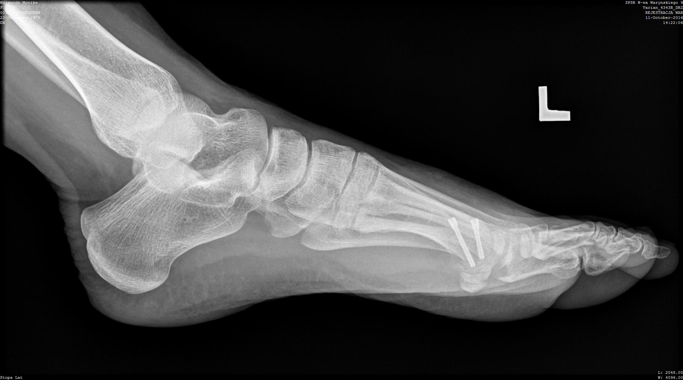 Paluch sztywny – operacje naprawcze (usunięcie osteofitów, cheilectomia, artrodeza)