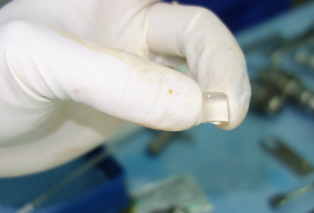 Leczenie palucha sztywnego – implant Cartiva