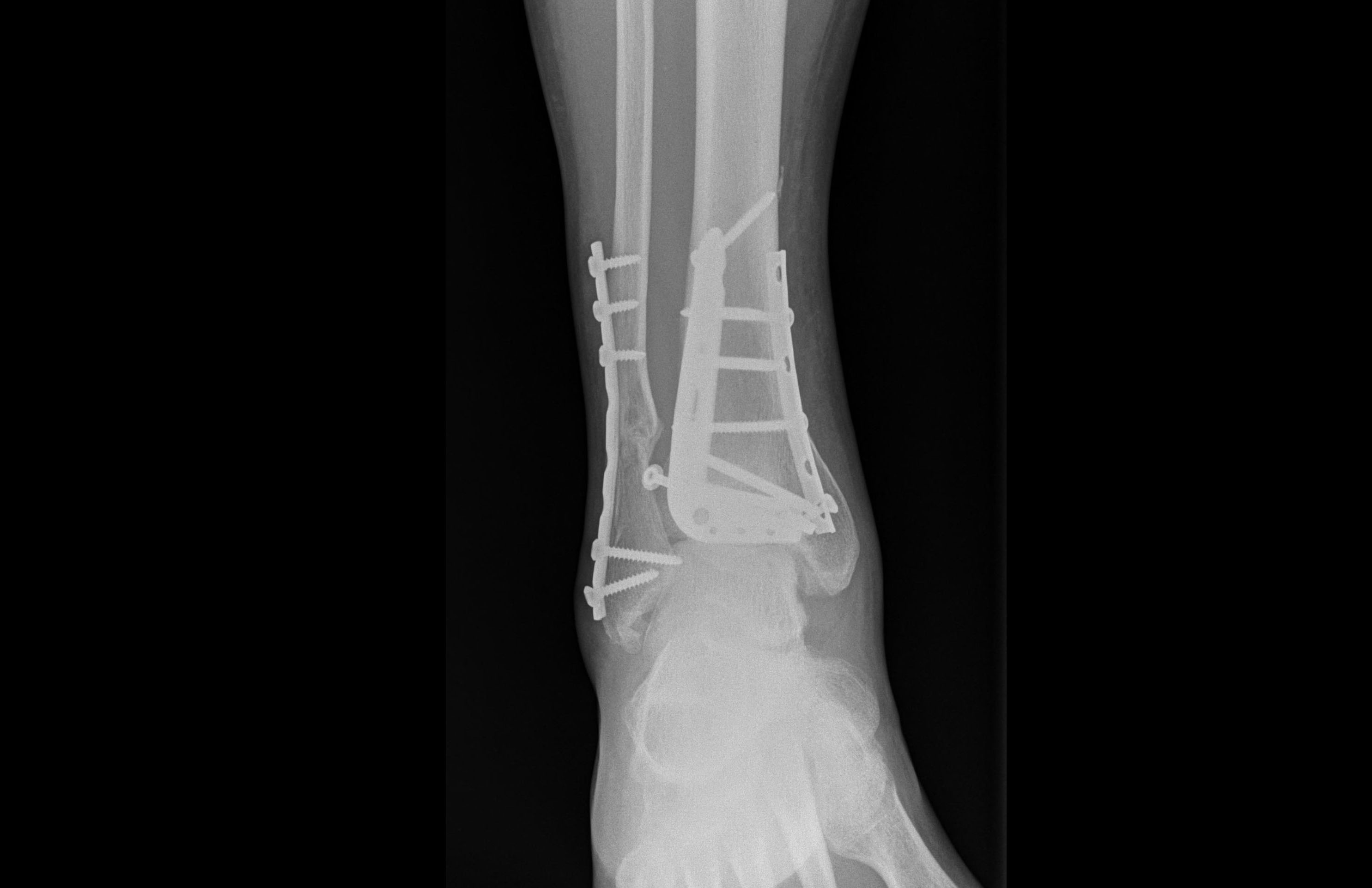 Usunięcie materiału zespalającego