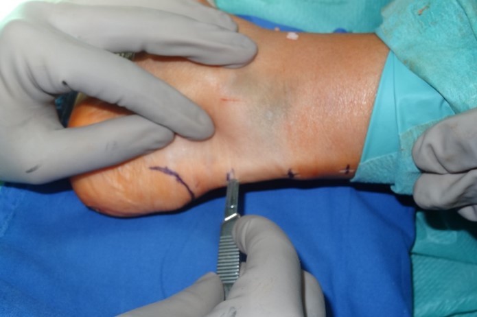 Wydłużanie ścięgna Achillesa