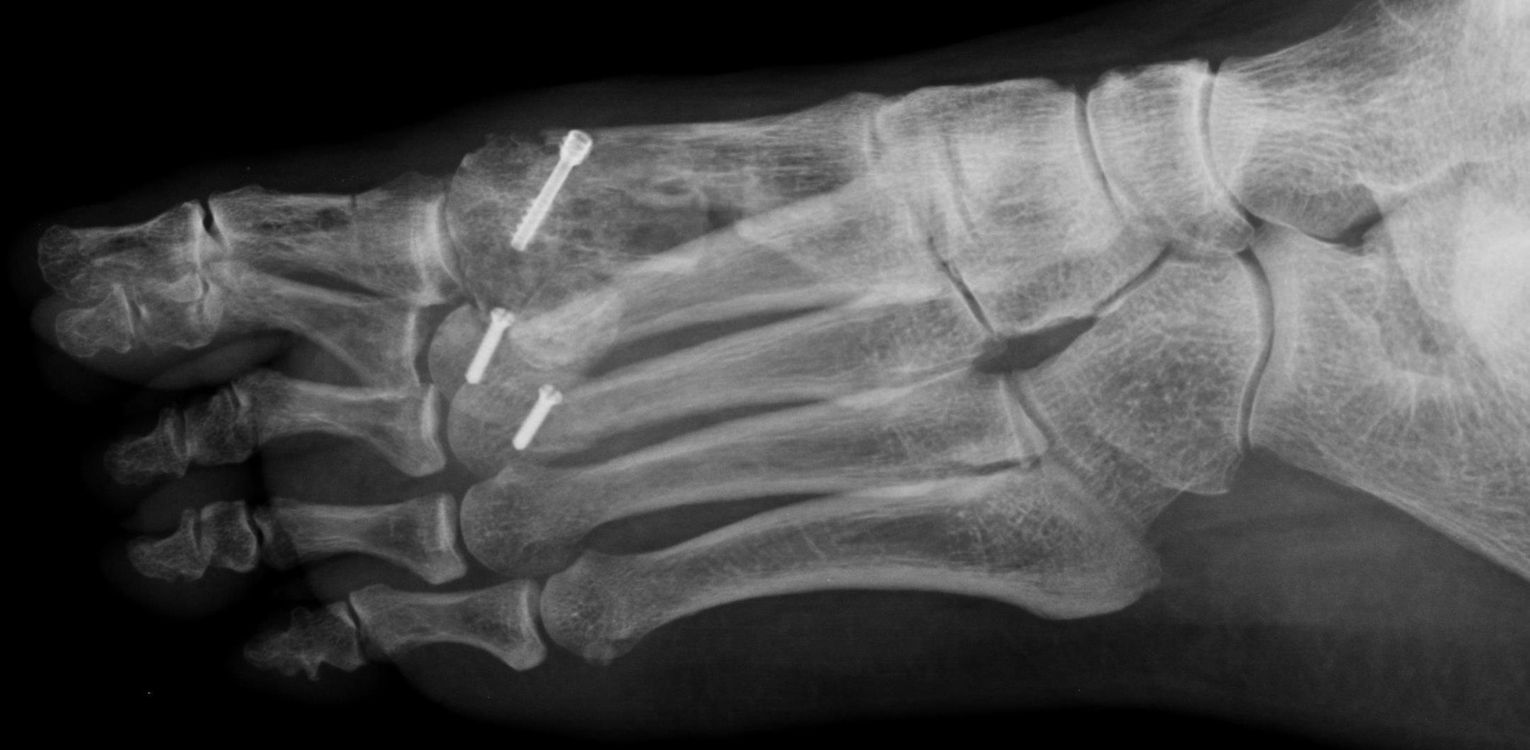 Płaskostopie poprzeczne – korekcje