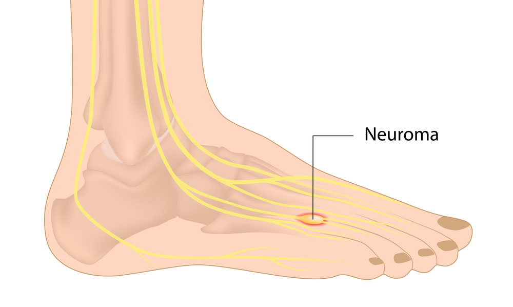 Operacje nerwiaka Mortona