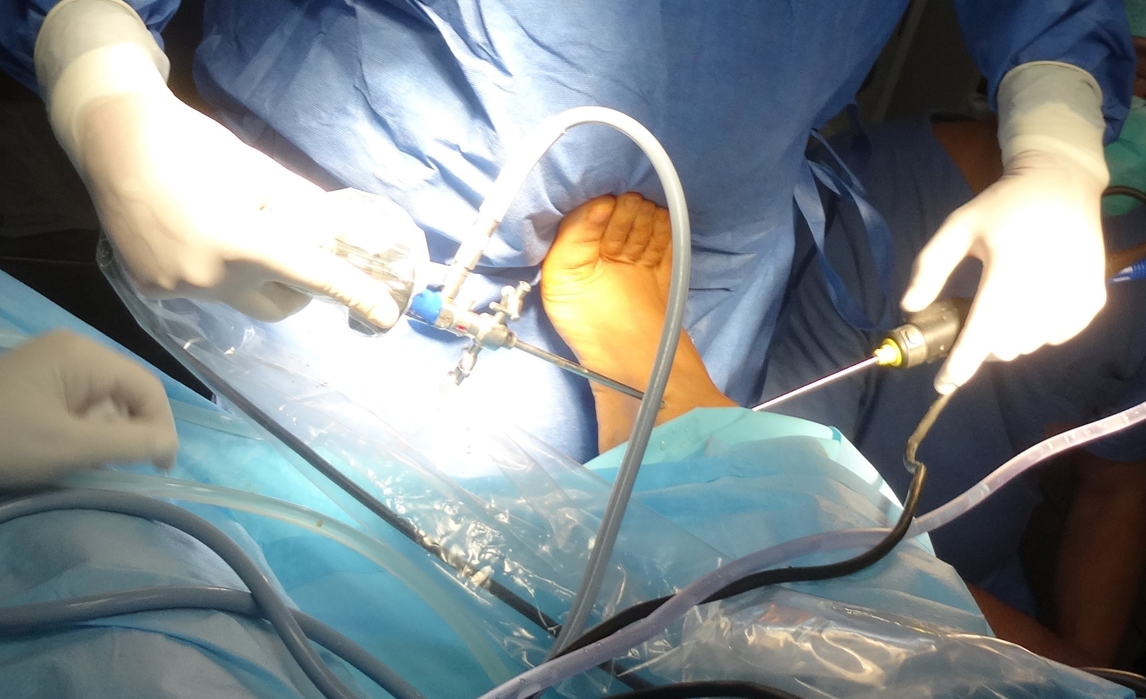 Artroskopowe leczenie niestabilności stawu skokowego