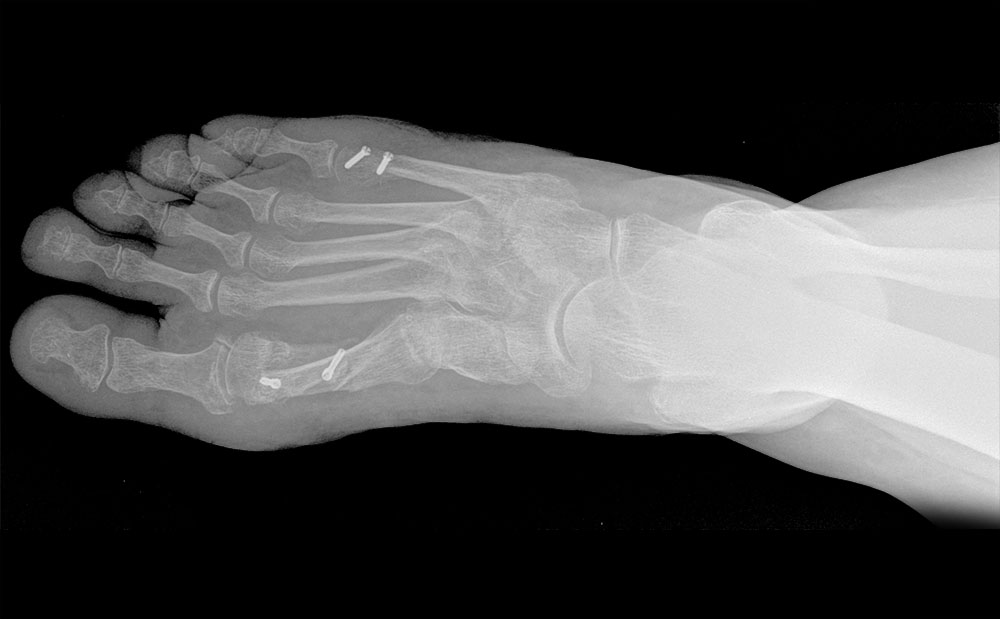 Deformacje stóp typu bunionette – korekcje