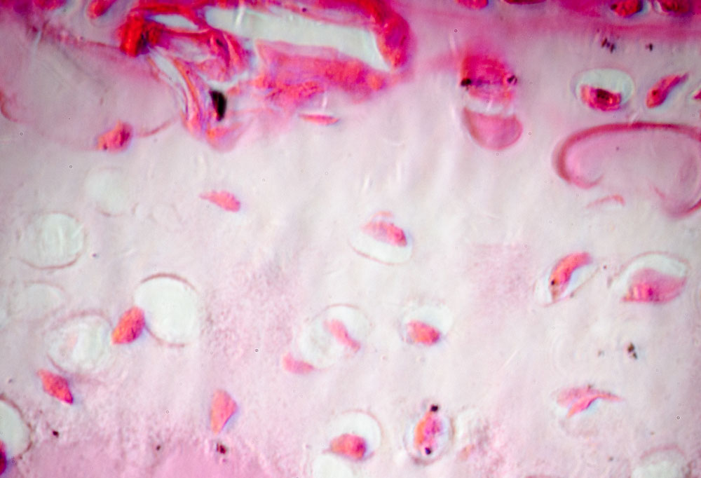 Leczenie uszkodzeń chrząstki stawowej