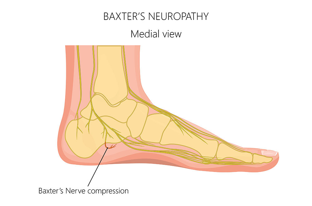 Operacje innych neuralgii w obrębie stopy