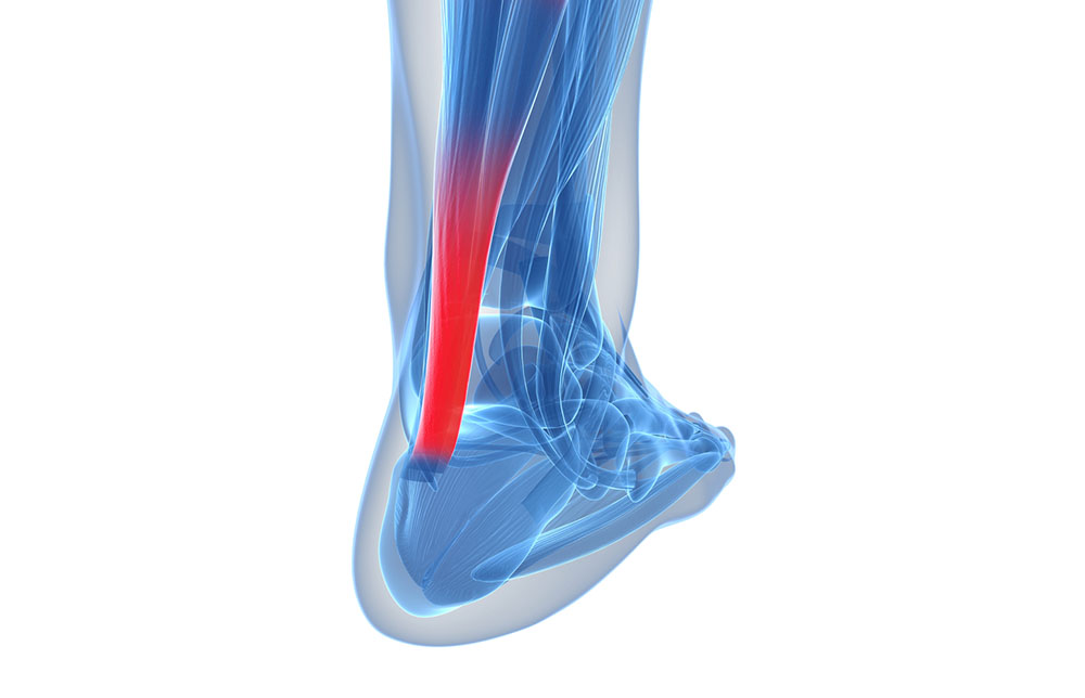 Operacje zerwanego ścięgna Achillesa (rekonstrukcja metodą klasyczną i miniinwazyjną)