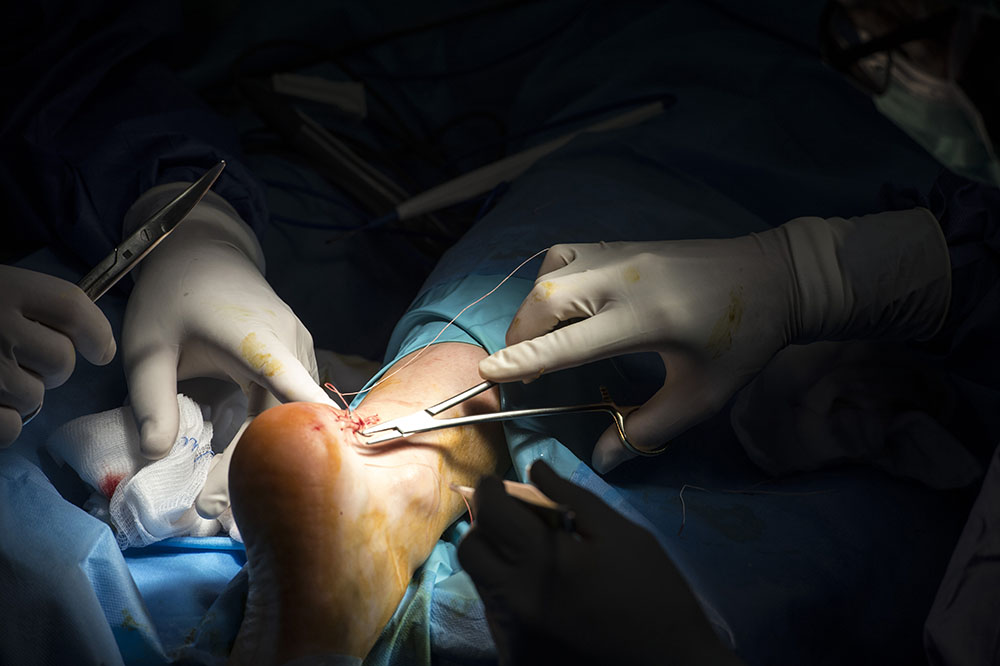 Zapalenie ścięgna Achillesa leczenie operacyjne