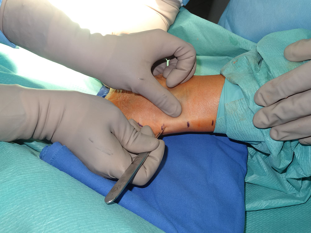 Wydłużenie ścięgna Achillesa