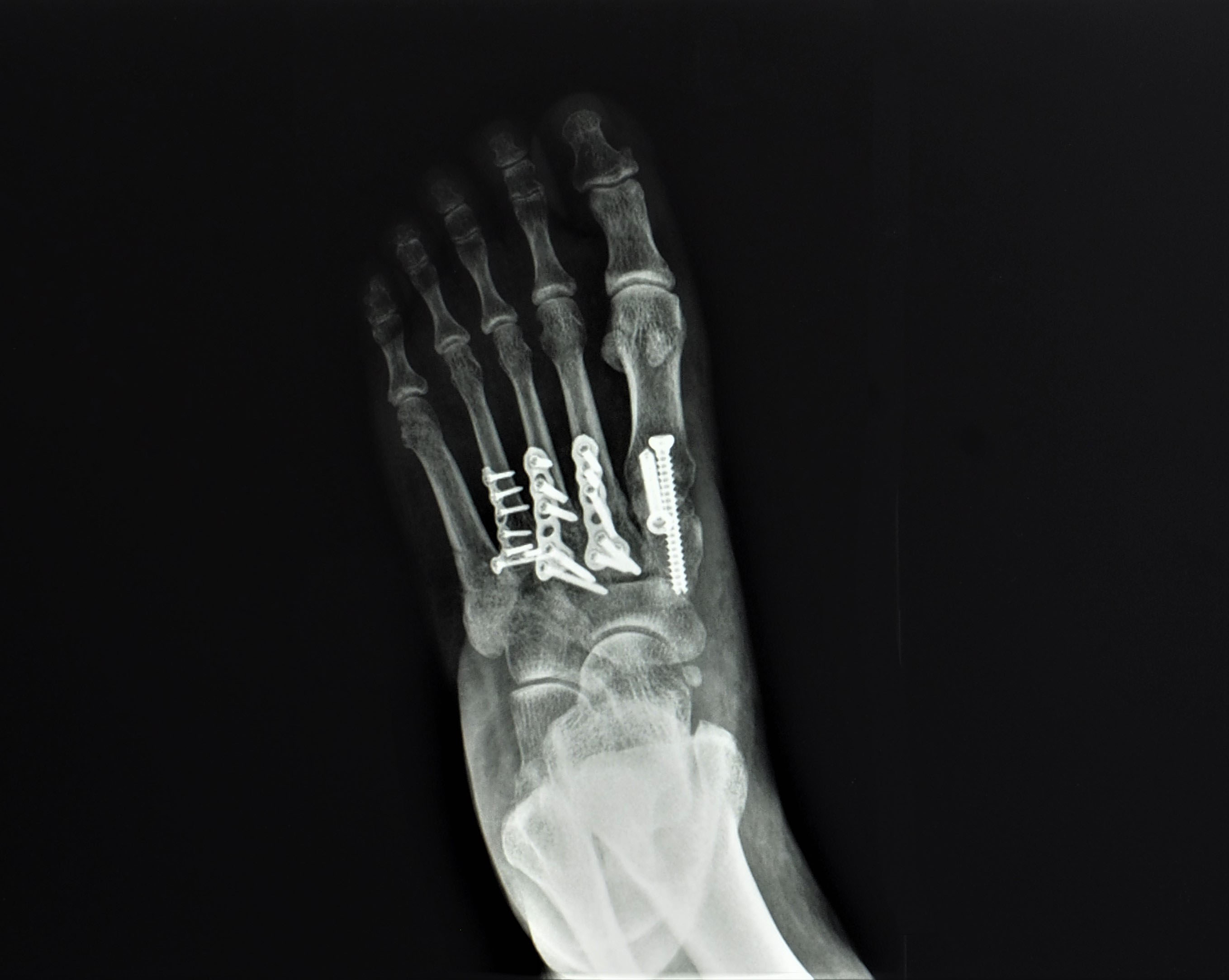 Operacje uszkodzeń stawu Lisfranca