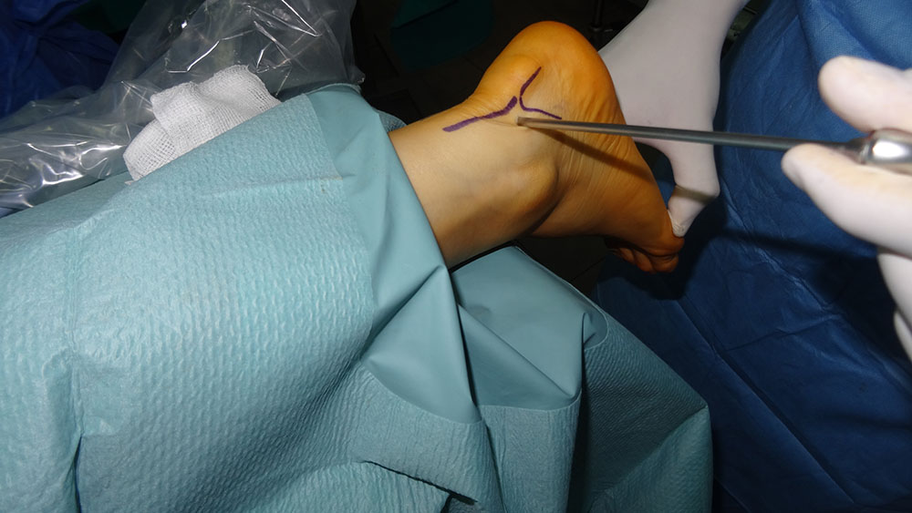 Operacje zespołu kości trójkątnej