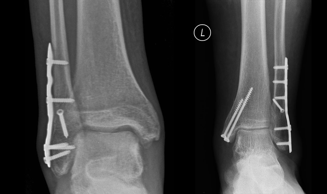 Złamanie kostek goleni (operacje z użyciem nowoczesnych tytanowych implantów)